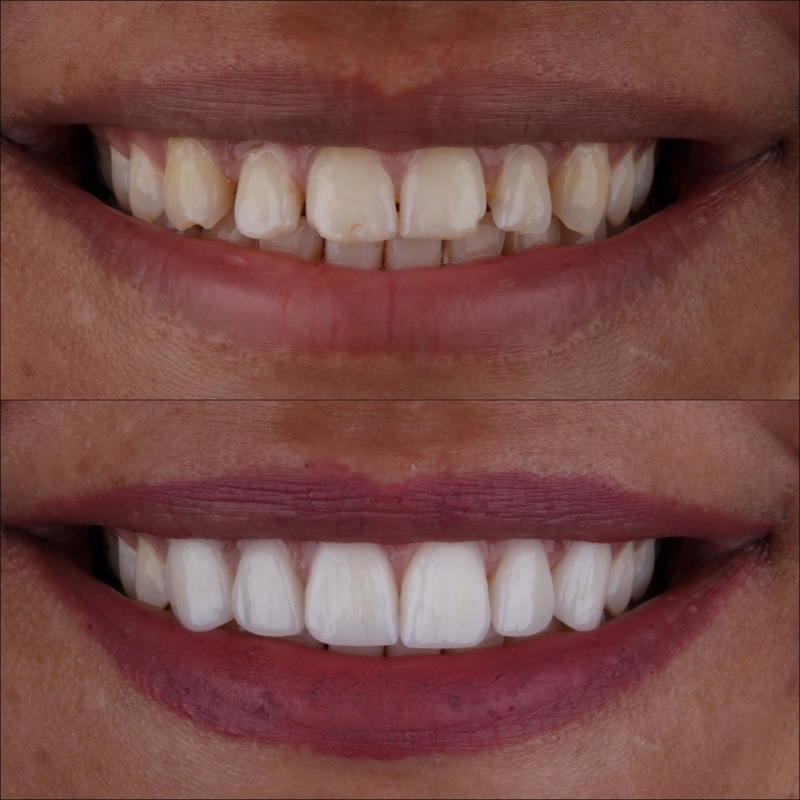 Mặt dán sứ có thể áp dụng cho trường hợp răng thưa nhỏ, ố vàng