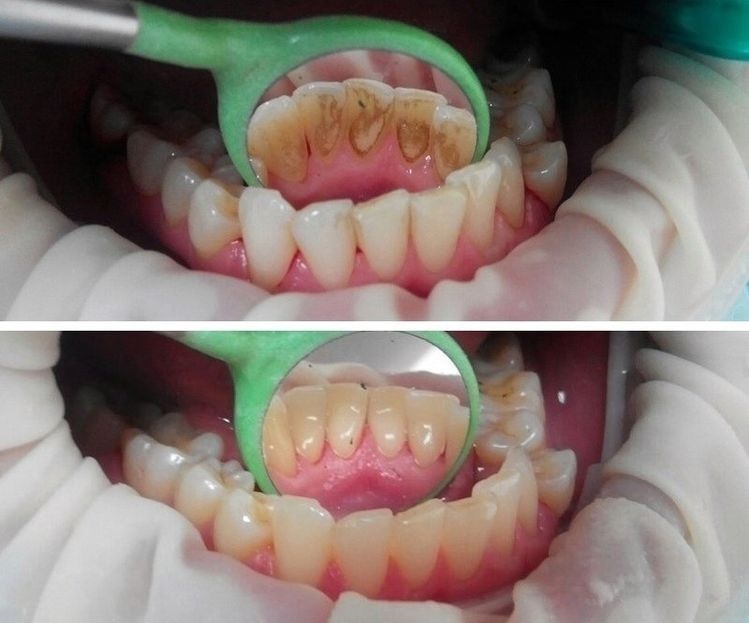 Cạo vôi răng giúp ngăn ngừa các bệnh về nướu răng