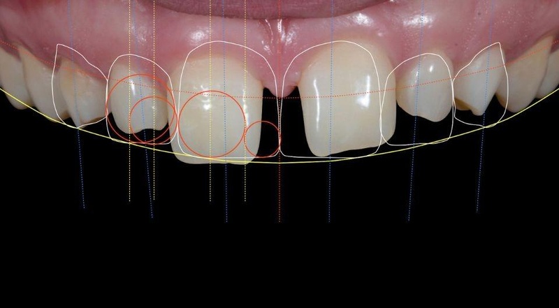 Thiết kế nụ cười cần tôn trọng các đặc điểm tự nhiên