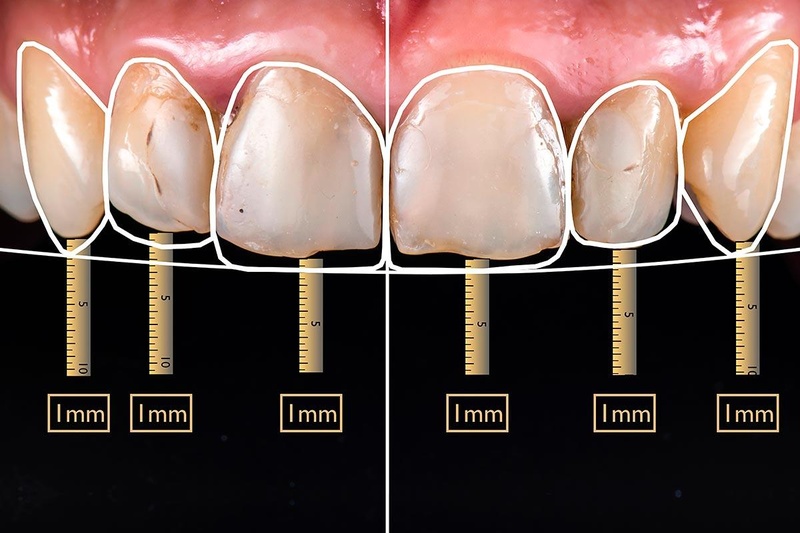 Thiết kế nụ cười là quy trình để nụ cười hài hòa về thẩm mỹ và chức năng