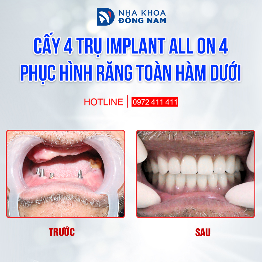 Cấy 4 trụ IL all-on-4 phục hình răng toàn hàm dưới