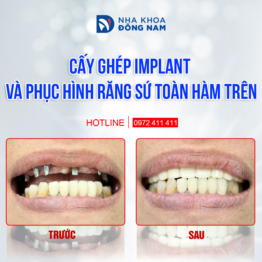 Cấy 6 trụ implant hàm trên và phục hình răng sứ