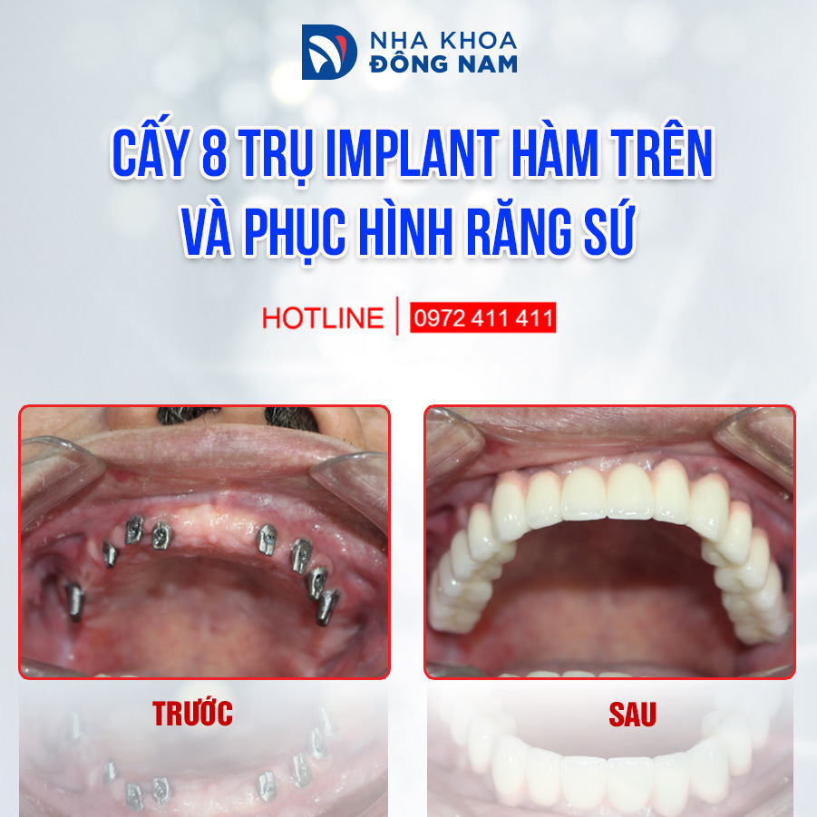 Cấy 8 trụ IL hàm trên và phục hình răng sứ