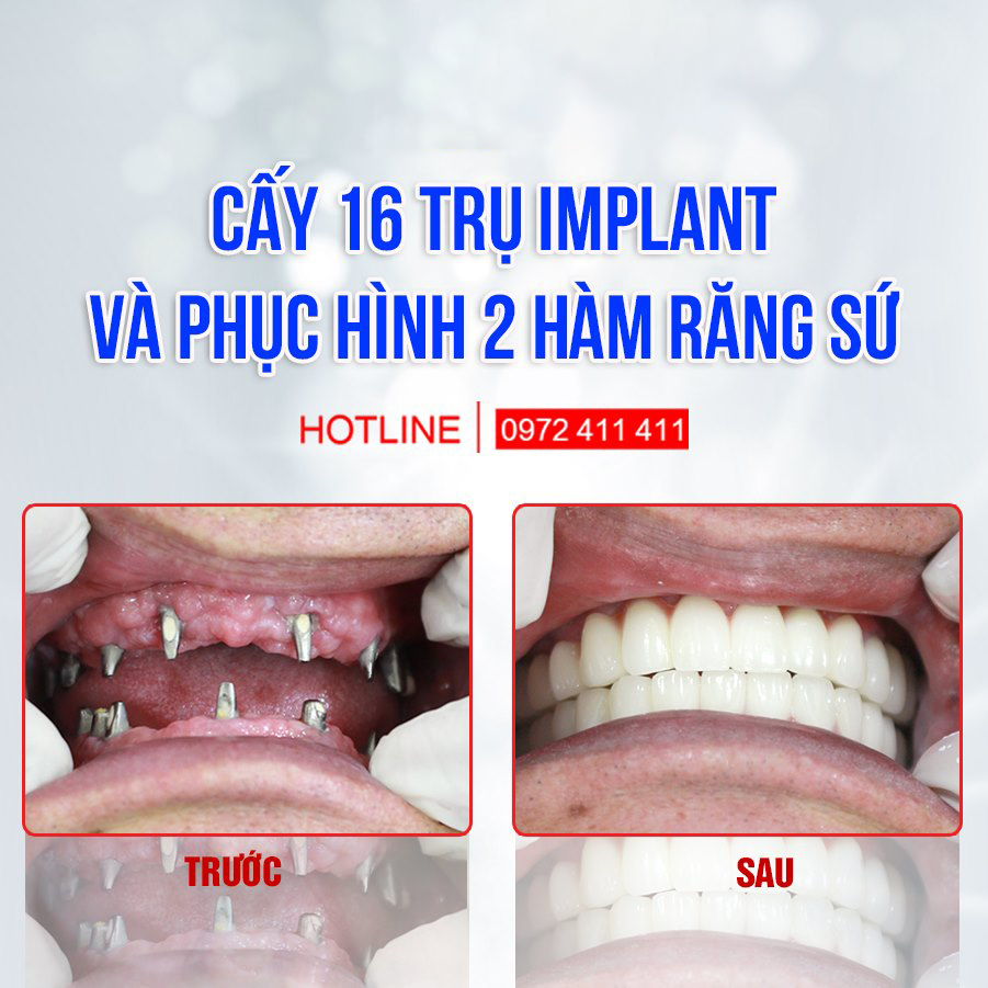 Cấy 16 trụ implant 2 hàm và phục hình 2 hàm sứ