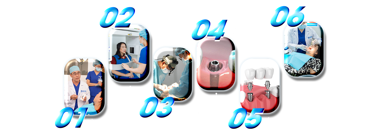 Quy trình trồng răng Implant chuẩn y khoa